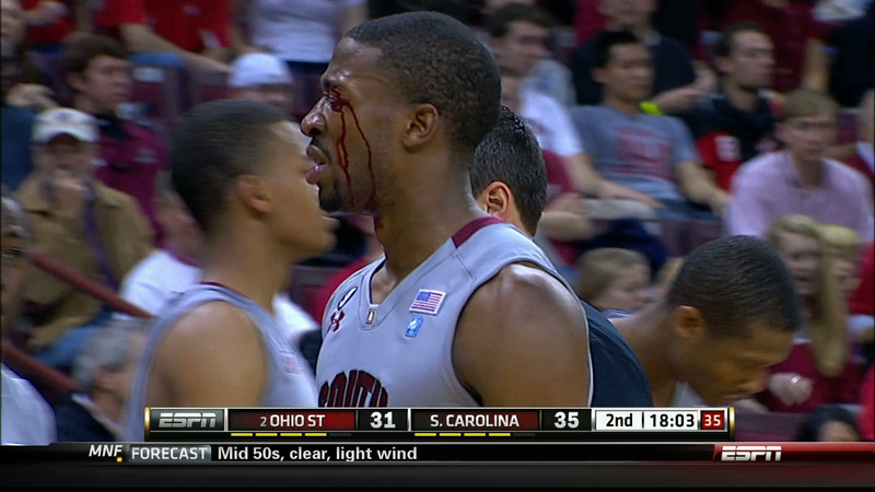 Illustration for article titled Body Parts Do Not Bend That Way: Gruesome Sports Injuries As Seen On TV